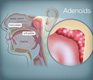 хронический аденоидит у детей симптомы