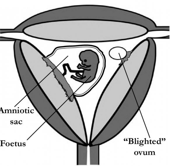 Плодное яйцо без эмбриона