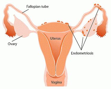 дюфастон при эндометриозе отзывы