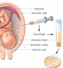 амниоцентез сроки