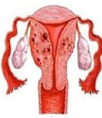 аденомиоз внутренний эндометриоз тела матки