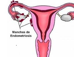 эндометриоз и аденомиоз разница