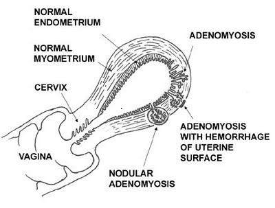 аденомиоз иногда называют внутренним эндометриозом