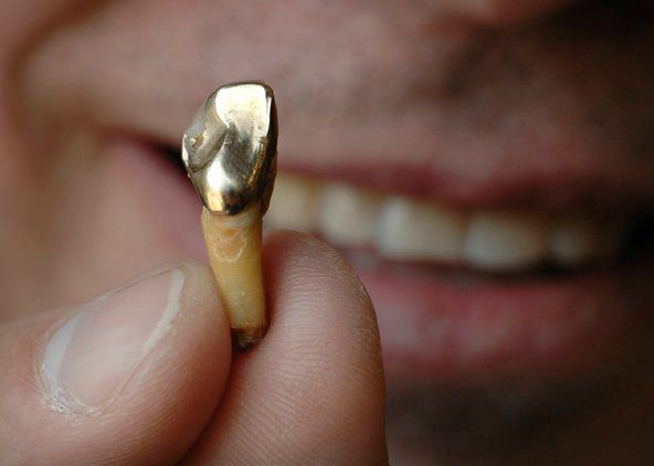 протезирование зубов при отсутствии большого количества зубов фото 