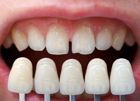  протезирование зубов виды какой протез лучше 