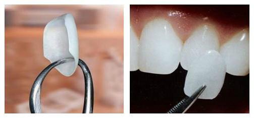 протезирование зубов как выбрать 