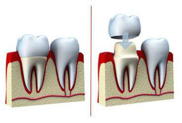 протезирование зубов при отсутствии большого количества зубов отзывы