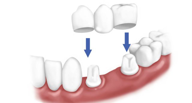 протезирование зубов при отсутствии большого количества зубов 