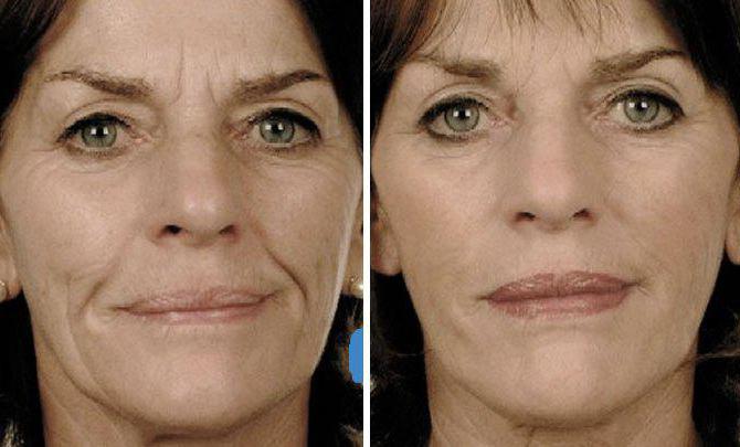 плазмолифтинг лица фото до и после 