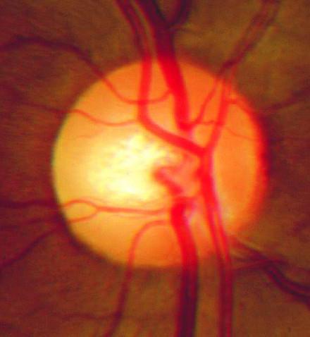 причиной развития застойного диска зрительного нерва являются