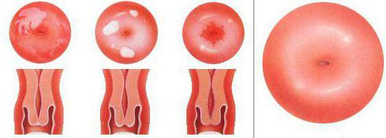 эрозия шейки матки у нерожавших девушек 