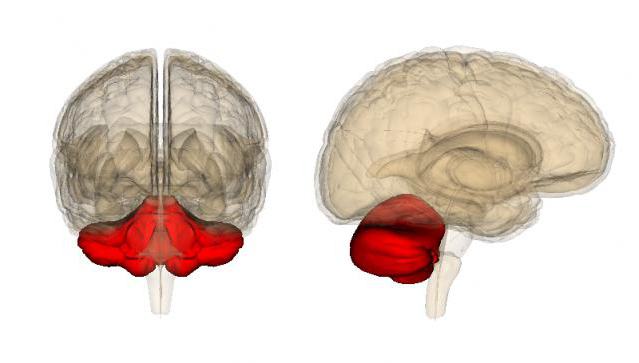 гипоплазия мозжечка у взрослого