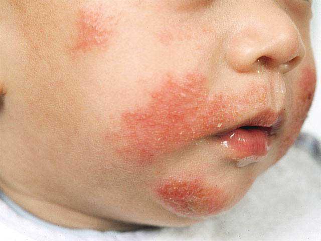 атопического дерматита у детей