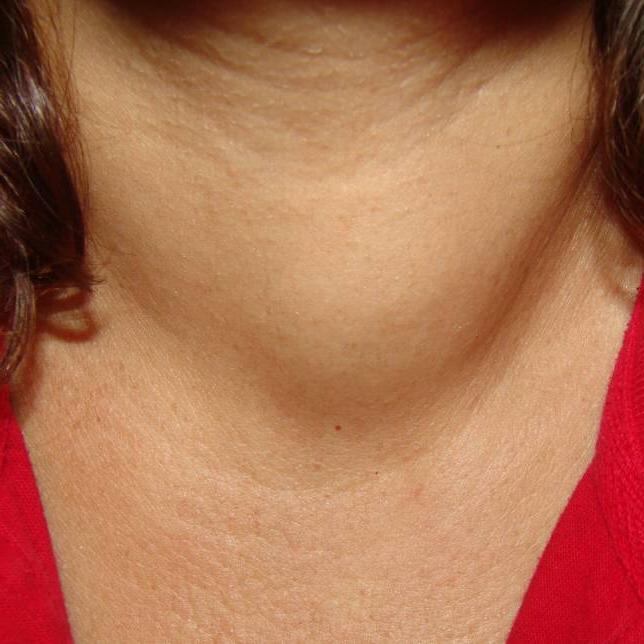 диффузно-узловой зоб щитовидной железы 