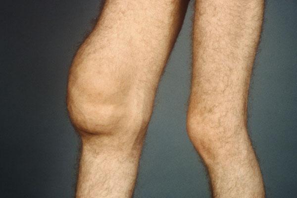 посттравматический синовит коленного сустава 
