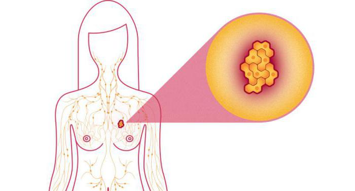 3 степень рака молочной железы продолжительность жизни