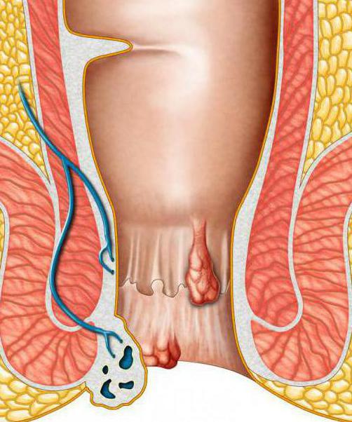 лекарства от геморроя у мужчин