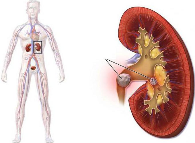 признаки камней в почках