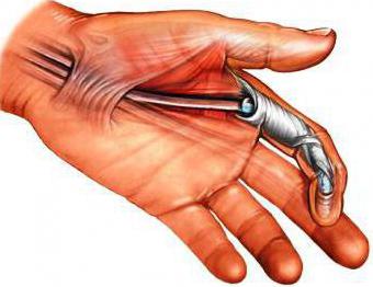 операция на кисти руки сухожилия
