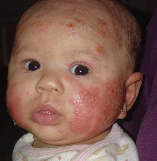 аллергия у ребенка как лечить отзывы