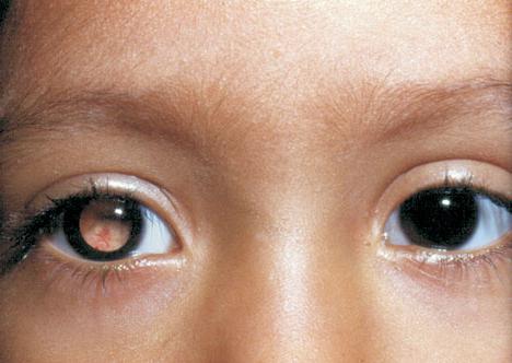 Рак глаза у детей