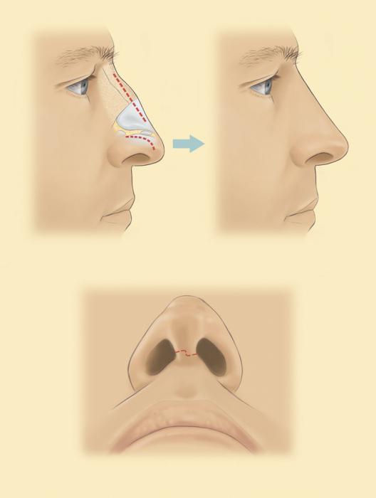 ринопластика кончика носа