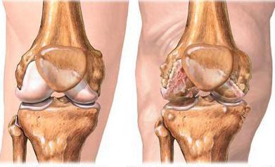воспаление связки коленного сустава симптомы лечение