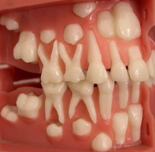 Схема прорезывания постоянных зубов
