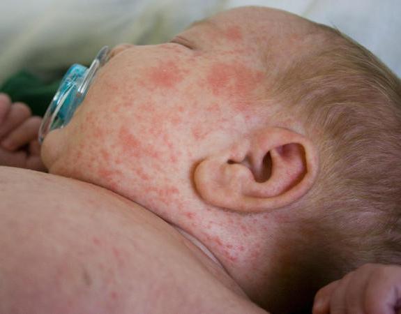 может ли быть аллергия у ребенка от капель в нос 