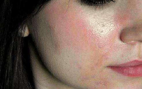 аллергия на капли в нос 