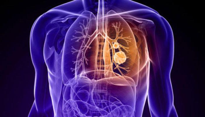 классификация туберкулеза легких