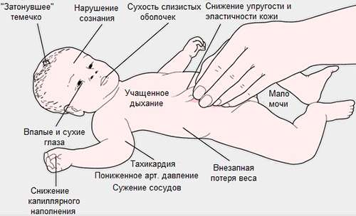 адреногенитальный синдром у новорожденных