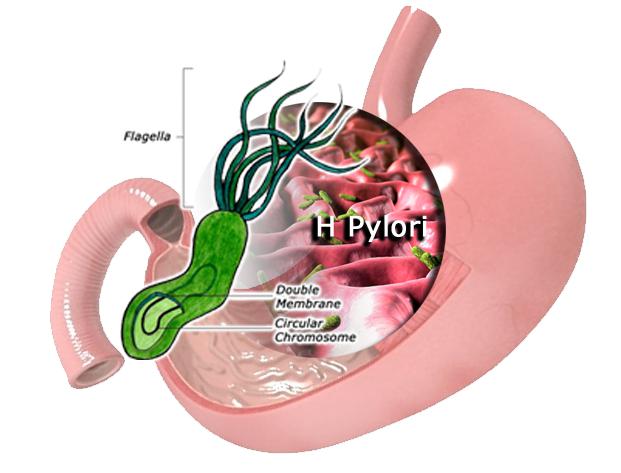 Желудок с Хилакобактери пилори