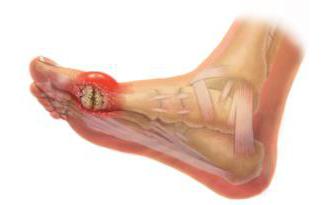 лечение отложения солей в пятках, коленях и пальцах ног