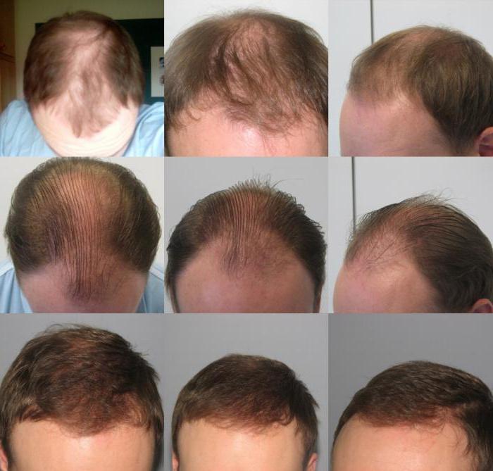 средство против выпадения волос pharmacia регейн