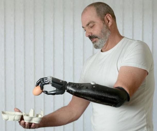 бионические протезы в России