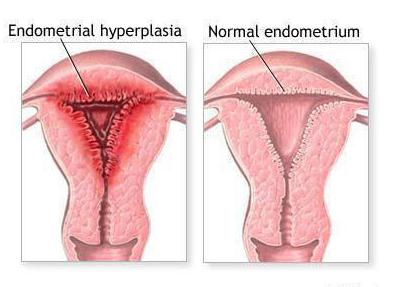 норколут при гиперплазии эндометрия