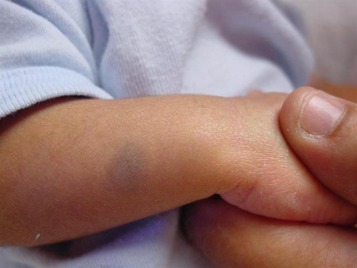 пигментные пятна на руке у ребенка