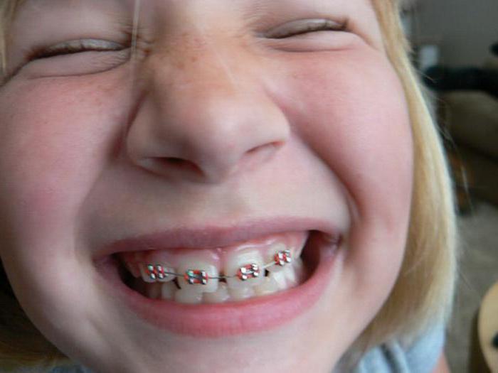 пластины для выравнивания зубов у детей фото