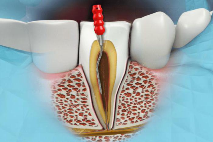 лечение кисты зуба без удаления в витебске