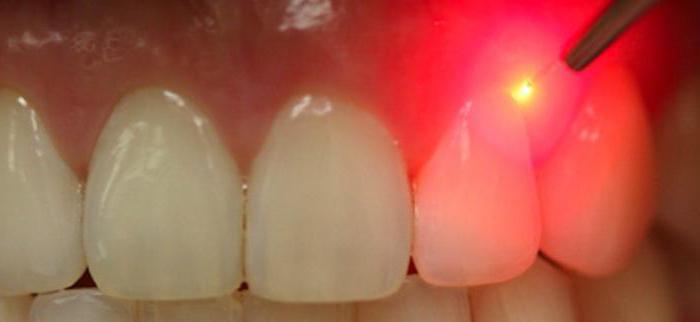 удаление кисты зуба лазером