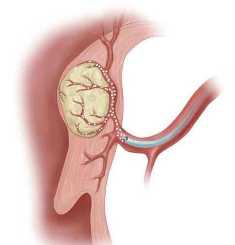 эмболизация маточных артерий при миоме матки