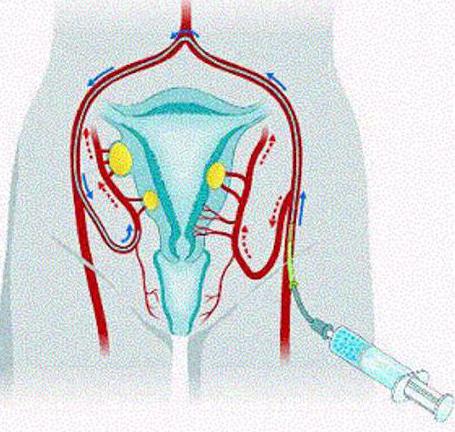 миома эмболизация