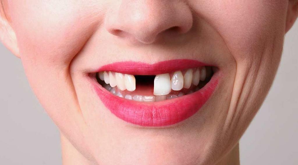 Отсутствие зубов меняет внешность