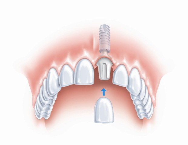 имплантация зубов противопоказания и возможные осложнения отзывы 