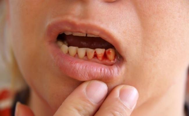 имплантация зубов какие бывают осложнения 