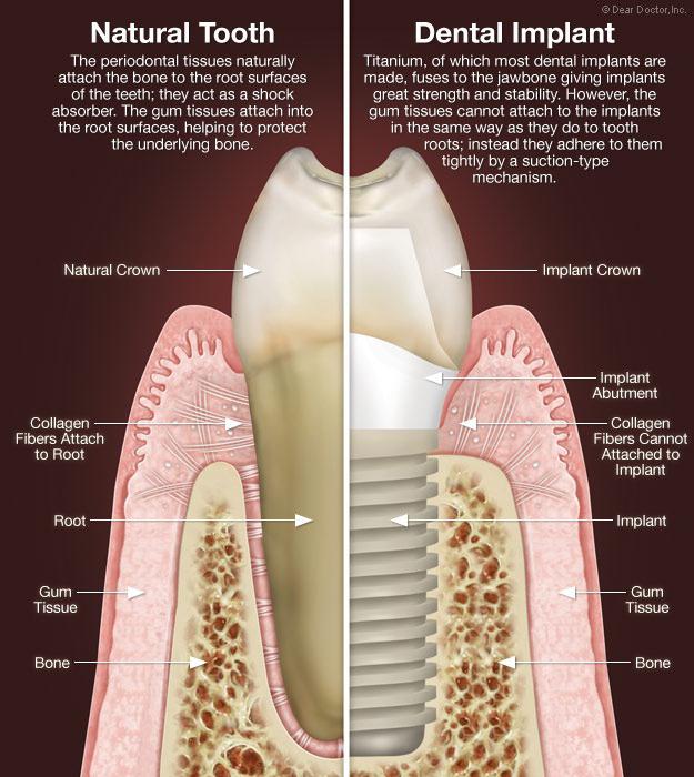 имплантация зубов бывают ли осложнения 