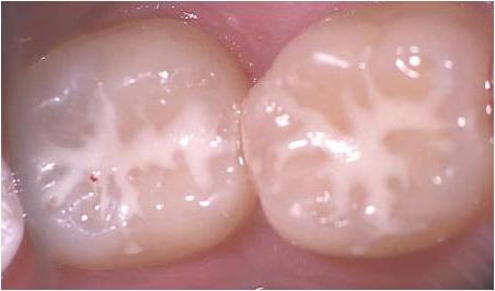 когда серебрение молочных зубов показано и когда нет