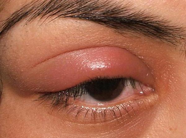 параорбитальная гематома глаза