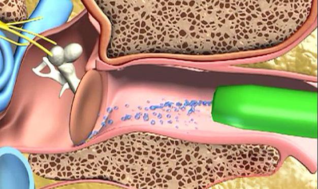 прибор для чистки ушей чистые ушки отзывы